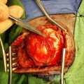 Epicranial Tumor Injury