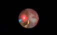 Kidney Stone - Laser