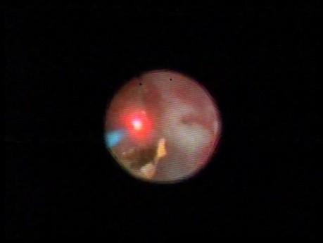 Kidney Stone - Laser