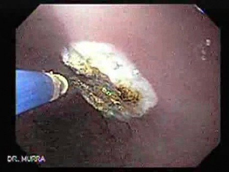 Endoscopic Ablation Of Barrett's Esophagus - 2/6