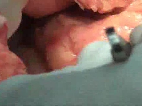 Multiple Rectal Ulcers (50 of 110)