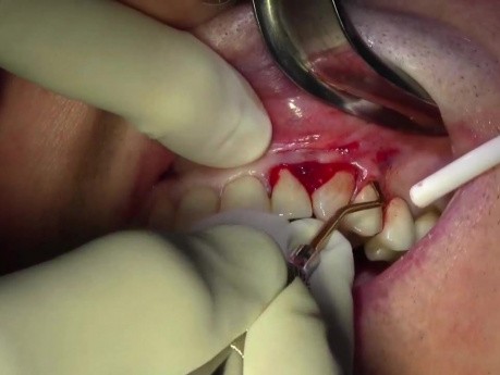 Gingival Grafting, #11 Facial Site - Quick Version