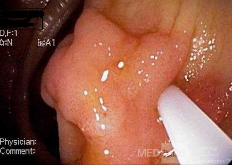 Tubulovillous Adenoma