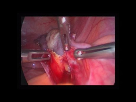 Ovarian Transposition
