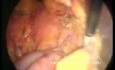 Left Paraduodenal Hernia - Laparoscopic Treatment