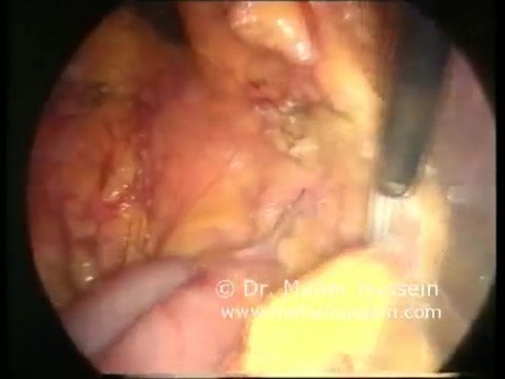 Left Paraduodenal Hernia - Laparoscopic Treatment