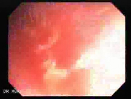 Diffuse Colonic Varices (3 of 4)