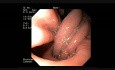 Gastroduodenal Invagination