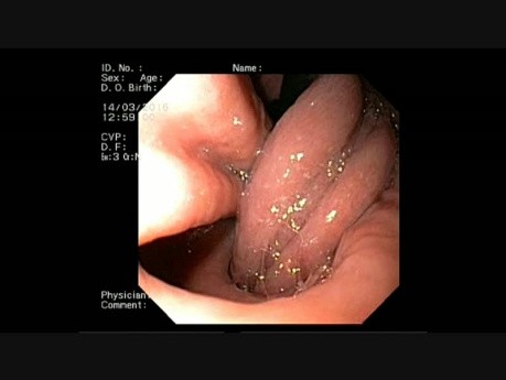 Gastroduodenal Invagination