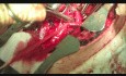 Surgical Disconnection Of Tracheo-Esophageal Fistula