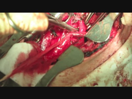Surgical Disconnection Of Tracheo-Esophageal Fistula