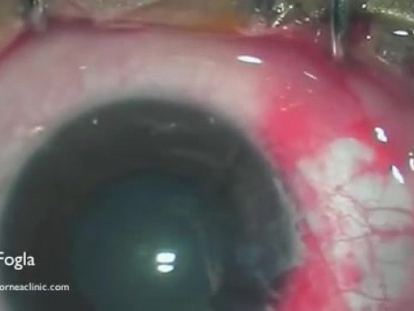 Conjunctival autograft- excision of pterygium
