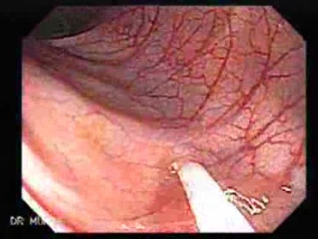 Non Familial Juvenile Polyposis Of The Colon (20 of 37)
