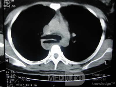 Esophagus - Pneumatic Dilation for Achalasia (30 of 31)