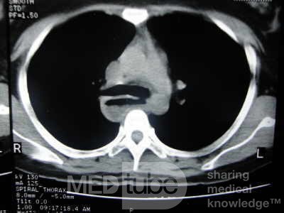 Esophagus - Pneumatic Dilation for Achalasia (30 of 31)