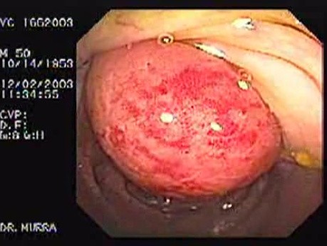 Diverticulitis Of Ileocecal Valve (1 of 5)