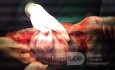 Cesarean Section in Twin Pregnancy