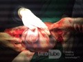 Cesarean Section in Twin Pregnancy