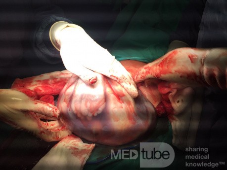 Cesarean Section in Twin Pregnancy