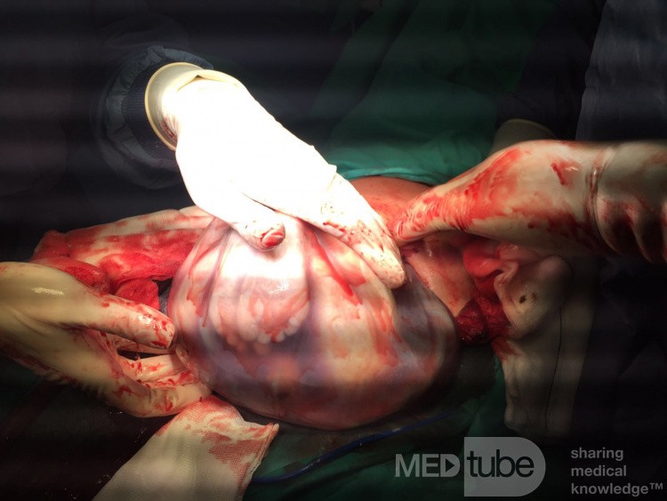 Cesarean Section in Twin Pregnancy