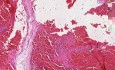 Ruptured varices - Histopathology of esophagus