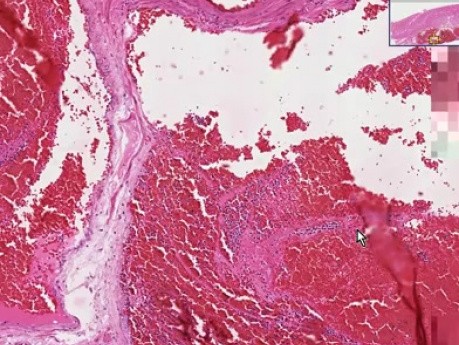 Ruptured varices - Histopathology of esophagus