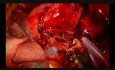 Uniportal VATS Double Sleeve Lobectomy (Vascular Anastomosis)