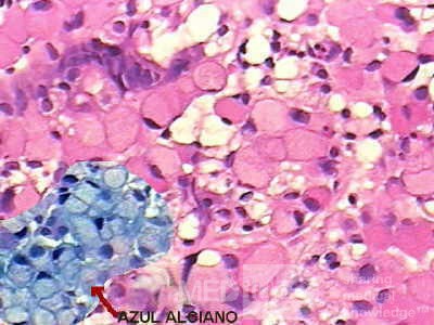 Small Gastric Adenocarcinoma of the Diffuse Ring Cell (6 of 19)