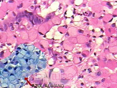 Small Gastric Adenocarcinoma of the Diffuse Ring Cell (6 of 19)