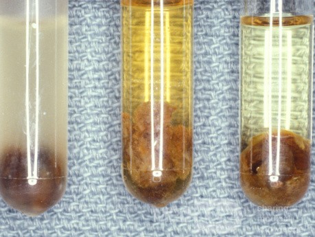 Cerumenolytics That Do Not Work