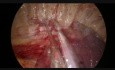 Uniportal Vats Sleeve Reimplantation of Middle Lobe to Bronchus Intermedius