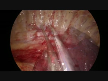 Uniportal Vats Sleeve Reimplantation of Middle Lobe to Bronchus Intermedius