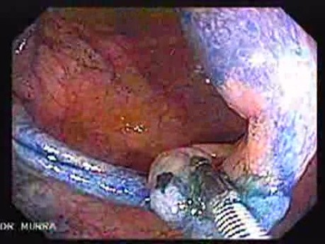 Sessile Tubulovillous Adenoma (8 of 13)