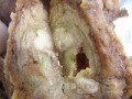 Cholangiocarcinoma that infiltrated a Periampullary Duodenal Diverticula and the head of the pancreas (13 of 20)