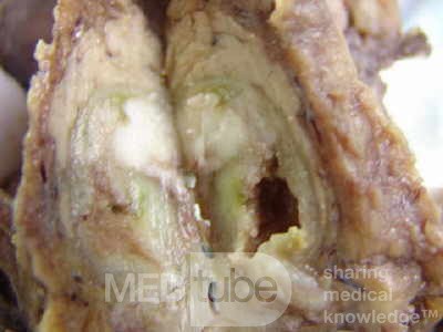 Cholangiocarcinoma that infiltrated a Periampullary Duodenal Diverticula and the head of the pancreas (13 of 20)