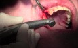Extraction, Palatal Pouch, Debridement - Extraction #5 with Socket Bone Grafting - d-PTFE