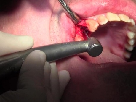 Extraction, Palatal Pouch, Debridement - Extraction #5 with Socket Bone Grafting - d-PTFE