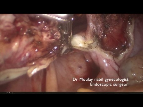 Total Laparoscopic Hysterectomy Using the Chardonnens Knife