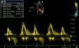 Pseudo-Normal Mitral Inflow - Valsalva - Stage 2 Diastolic Dysfunction