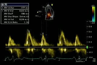 Pseudo-Normal Mitral Inflow - Valsalva - Stage 2 Diastolic Dysfunction