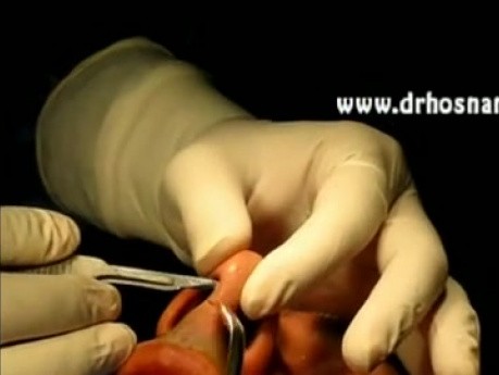 Open Rhinoplasty video performed by Dr Hosnani