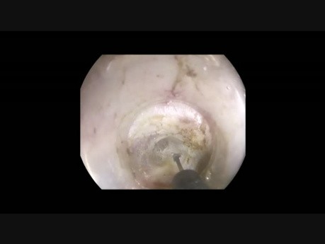 POEM in Severe Achalasia