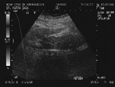 Ovarian Carcinoma with Gastric and Duodenal Metastases  - Ultrasonography of the Abdomen, Part 2
