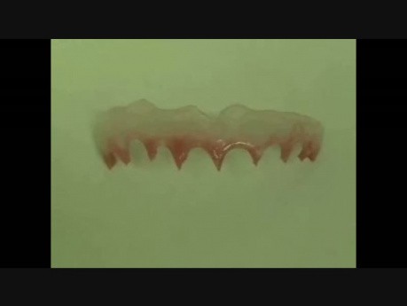 Gingival Mask Prosthetic Artistic Solution - Tissue Regeneration