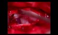 Spinal Tumor (Neuroma) LWK2/3