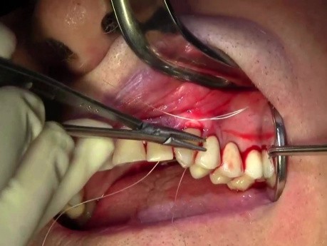 Gingival Grafting, #11 Facial Site - Full Version