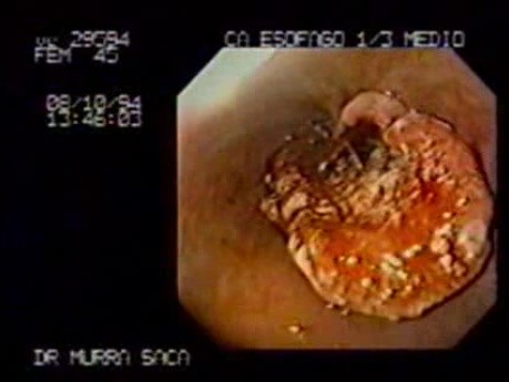 Esophageal Squamous Cell Carcinoma - 45 Year-Old Female With Progressive Dysphagia
