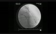 Coronary Angiogram 5 years after BIMA Coronary Grafting