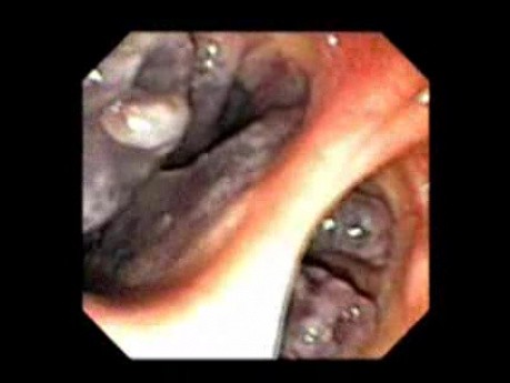 Nasopharynx (10 of 32) Retrograde Endoscopic View