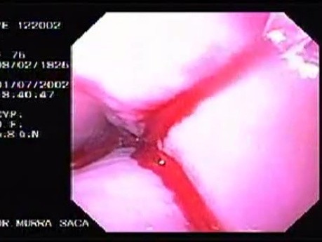 Hemorrhage due status post rubber band ligation of esophageal varices (16 of 25)